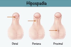 Hipospádia peniana – Como é feita a correção?